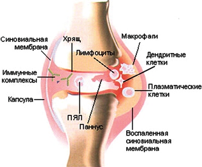 Лечение артрита в Израиле