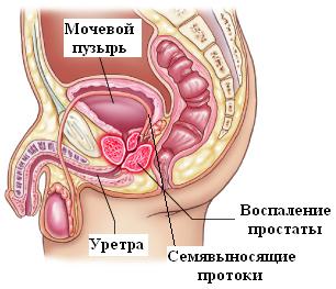 Tratamentul prostatitei și veziculitei