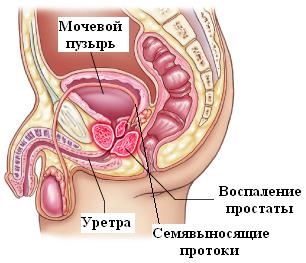 Лечение простатита в Израиле