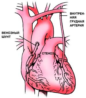 Шунтирование сердца в Израиле