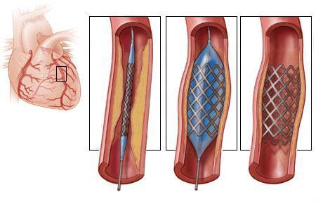 коронарная ангиопластика
